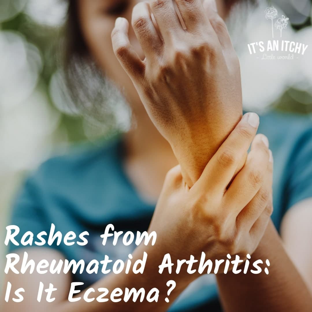 Eczema and Arthritis: Are They Connected?