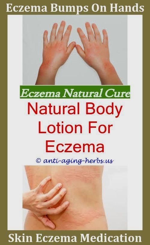 Eczema Disease Does Stress Cause Eczema Infant Eczema # ...