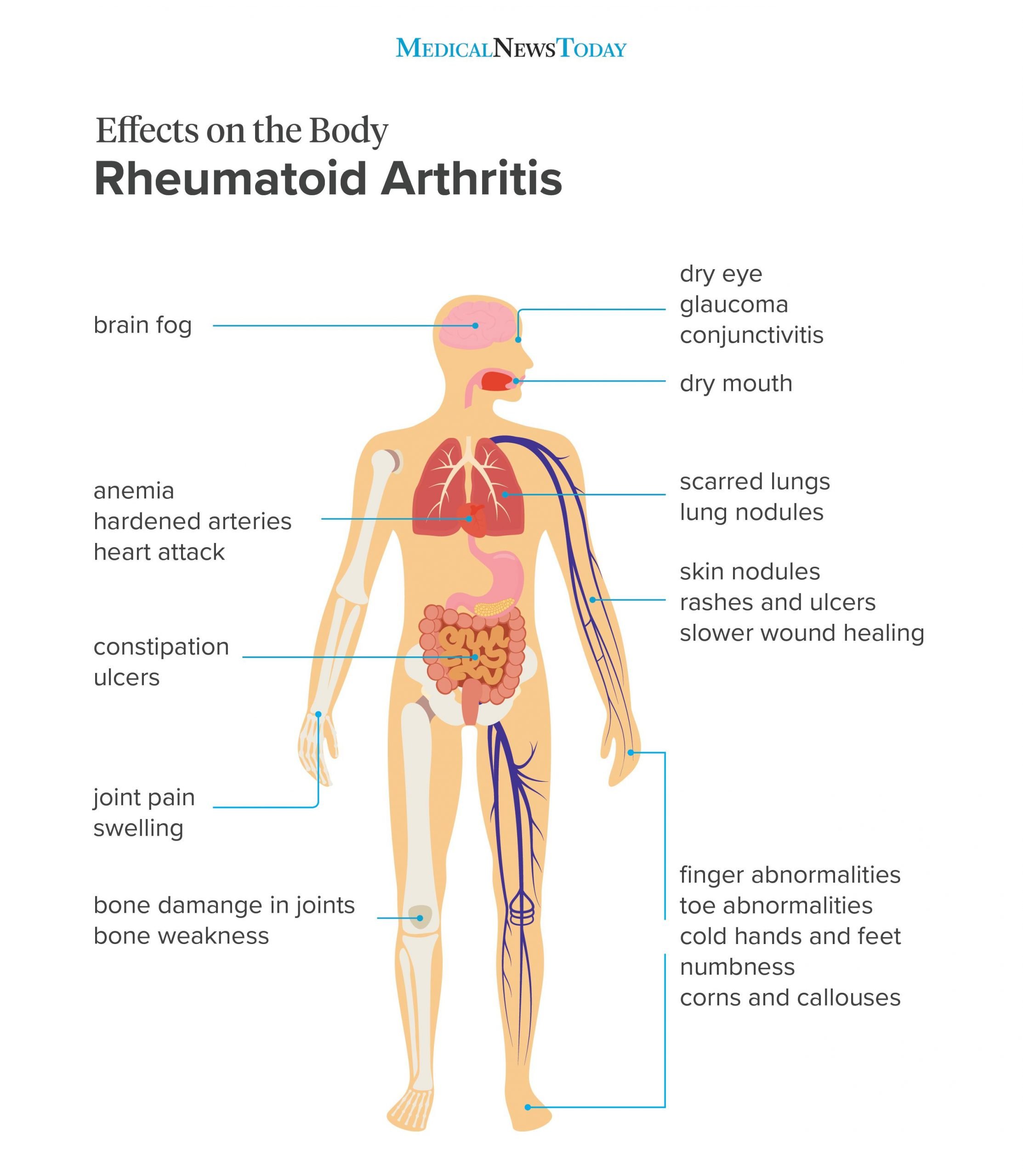 Effects of rheumatoid arthritis on the body