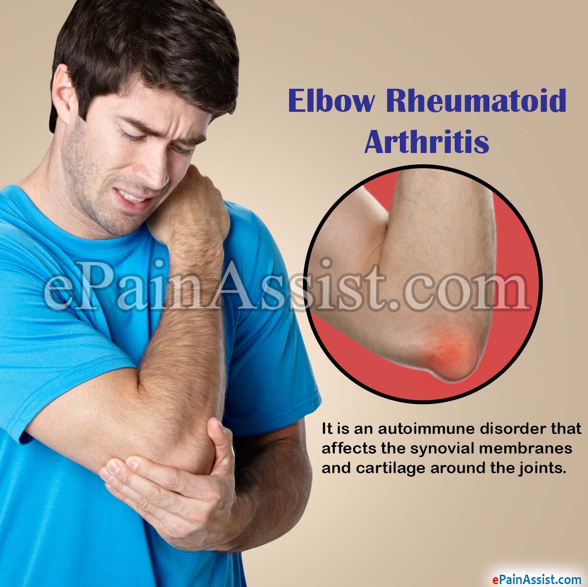 Elbow Rheumatoid Arthritis