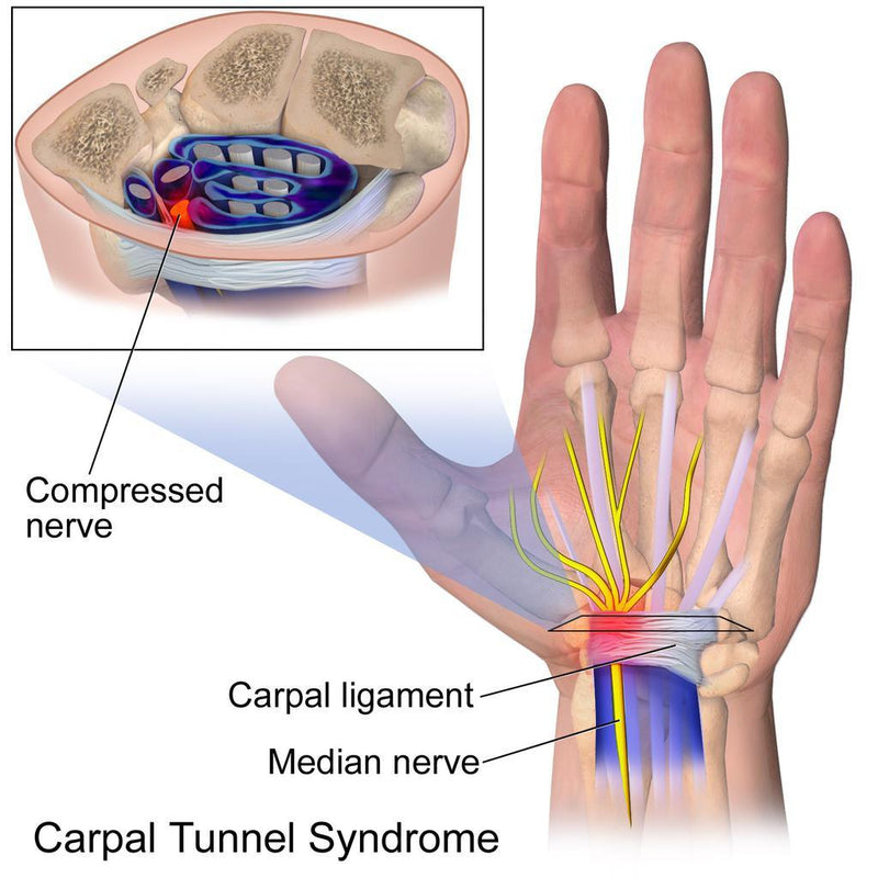 Essential Wellness Physiotherapist Health Guides Tagged " Carpal Tunnel ...