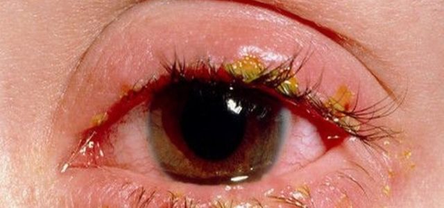 Eye Symptoms Of Psoriatic Arthritis