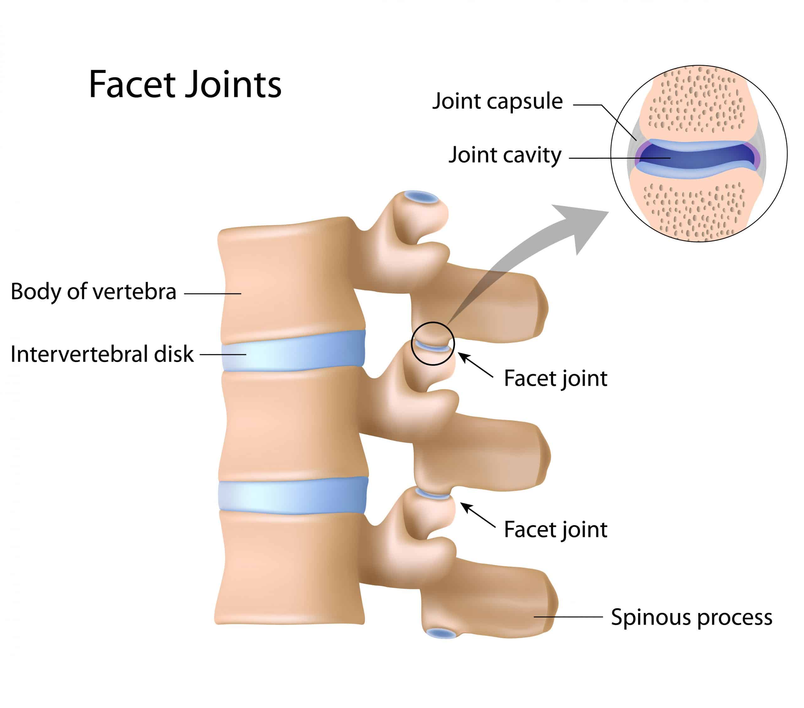 Facet Arthropathy Causes, Symptoms &  Treatments
