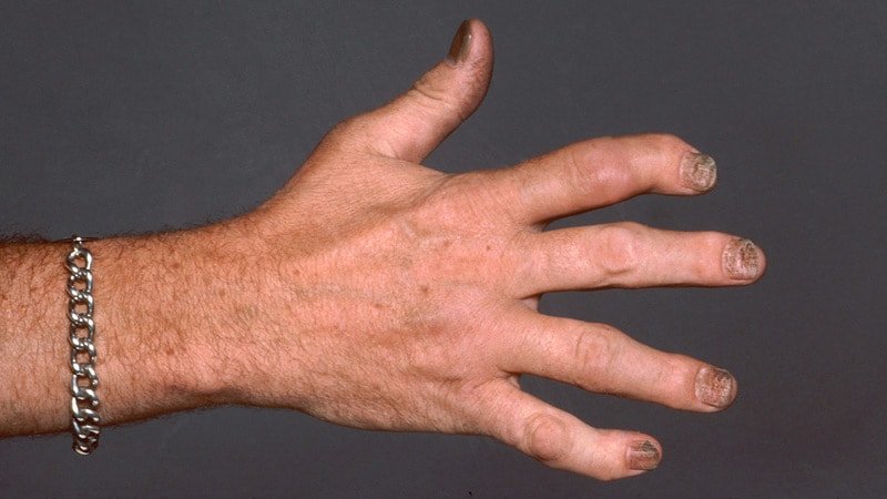 Fast Five Quiz: Psoriatic Arthritis