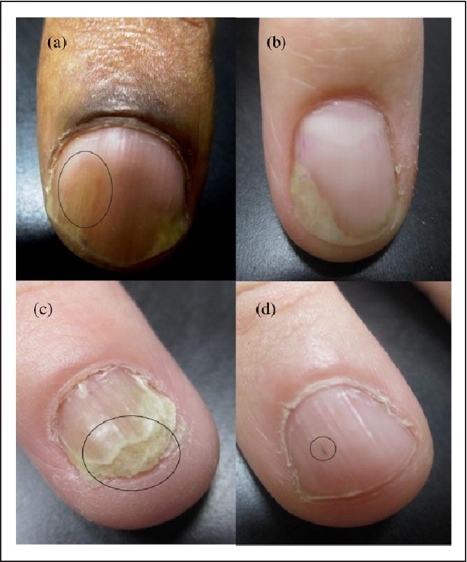 Figure 1 from Psoriatic Nail Changes Are Associated With Clinical ...