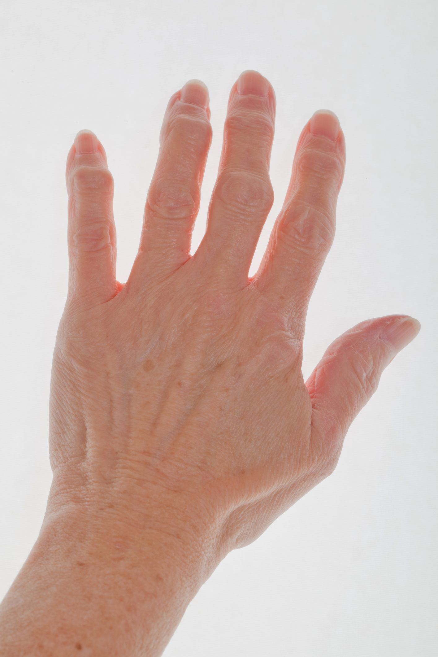 Finger Arthritis: Signs, Symptoms, and Treatment