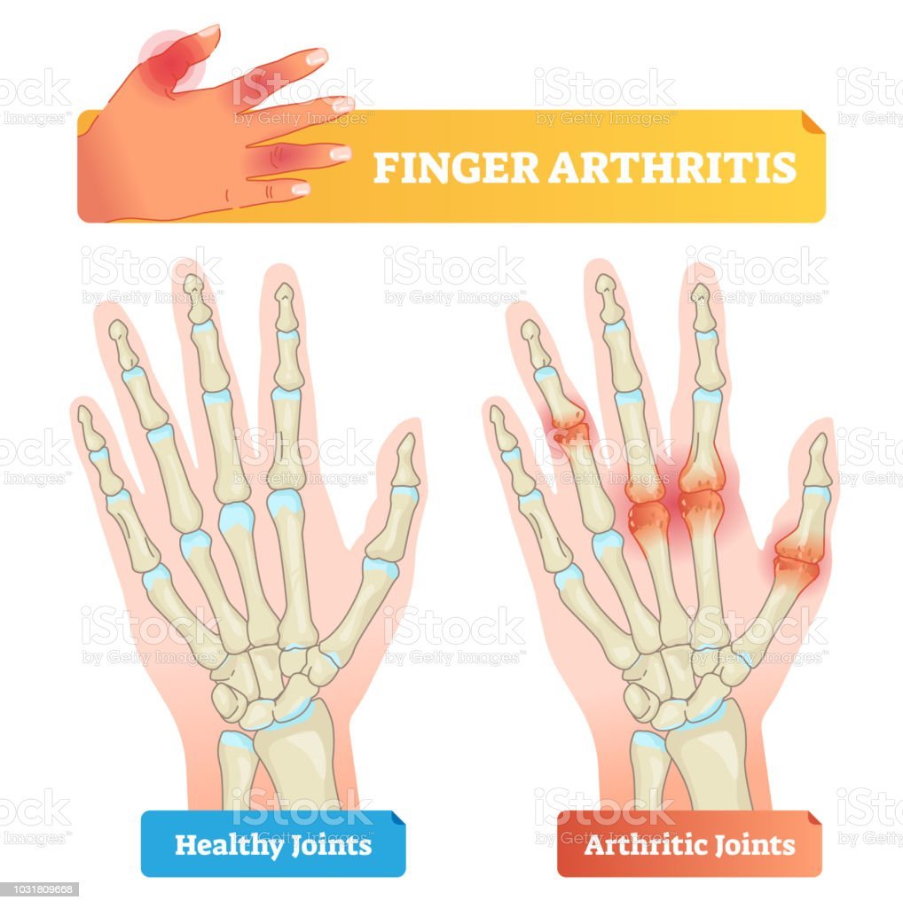Finger Arthritis Vector Illustration Healthy And Disease Affected ...