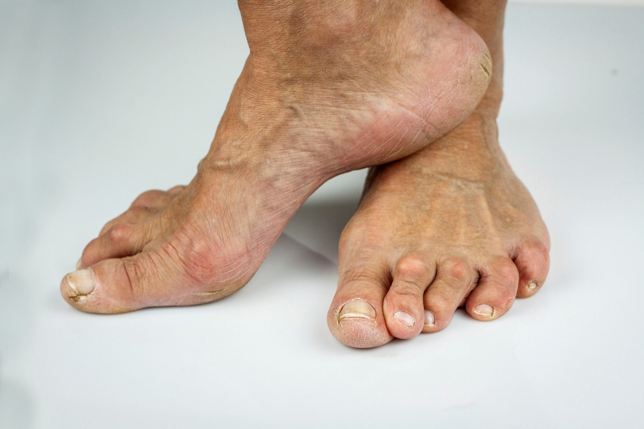 Foot Problems You May Experience as You Age