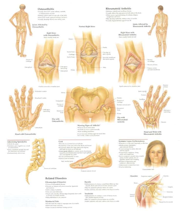 Free For Health: Common Rheumatoid Arthritis Symptoms