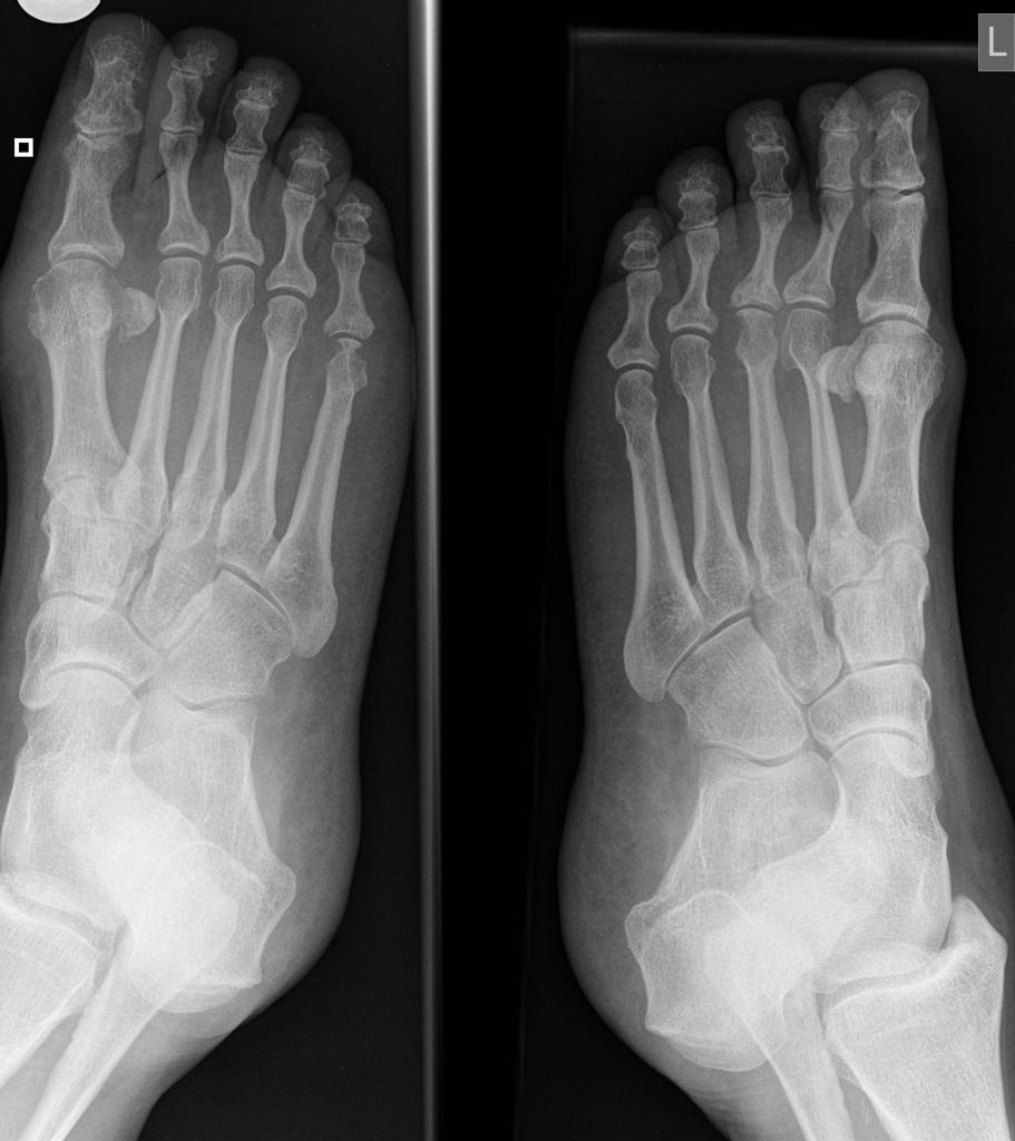 Get Rheumatoid Arthritis Feet PNG