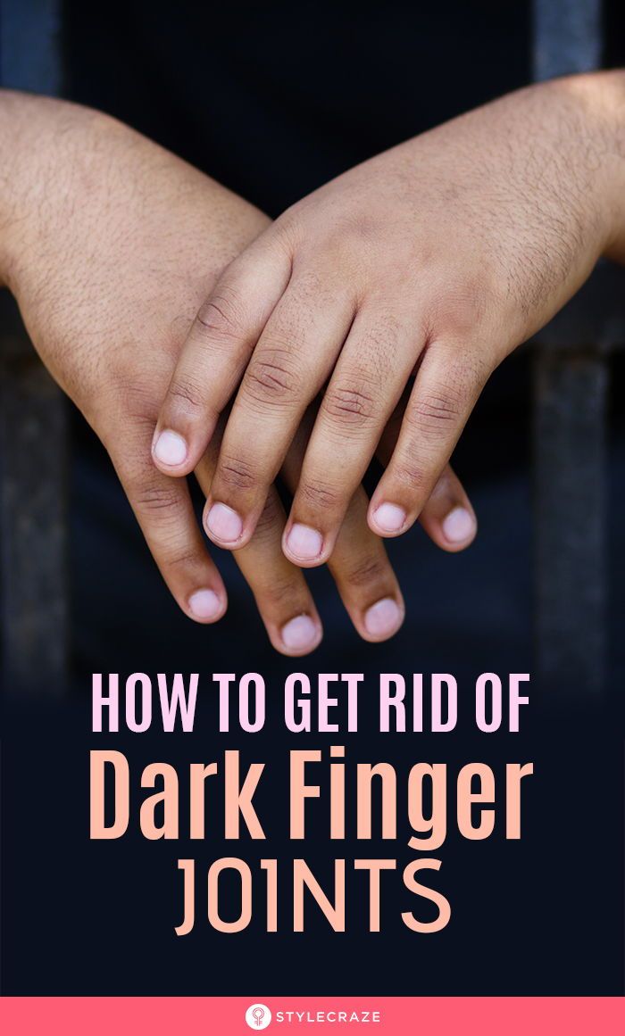 Get Rid Of Dark Fingers And Joints With These Simple ...