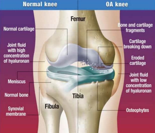 Glucosamine does not relieve knee osteoarthritis