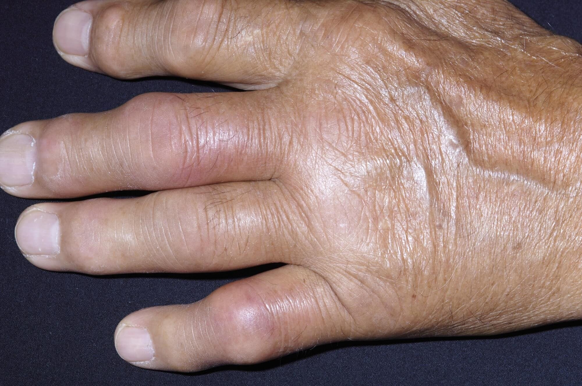Gout Associated With Psoriatic Arthritis, Psoriasis in ...