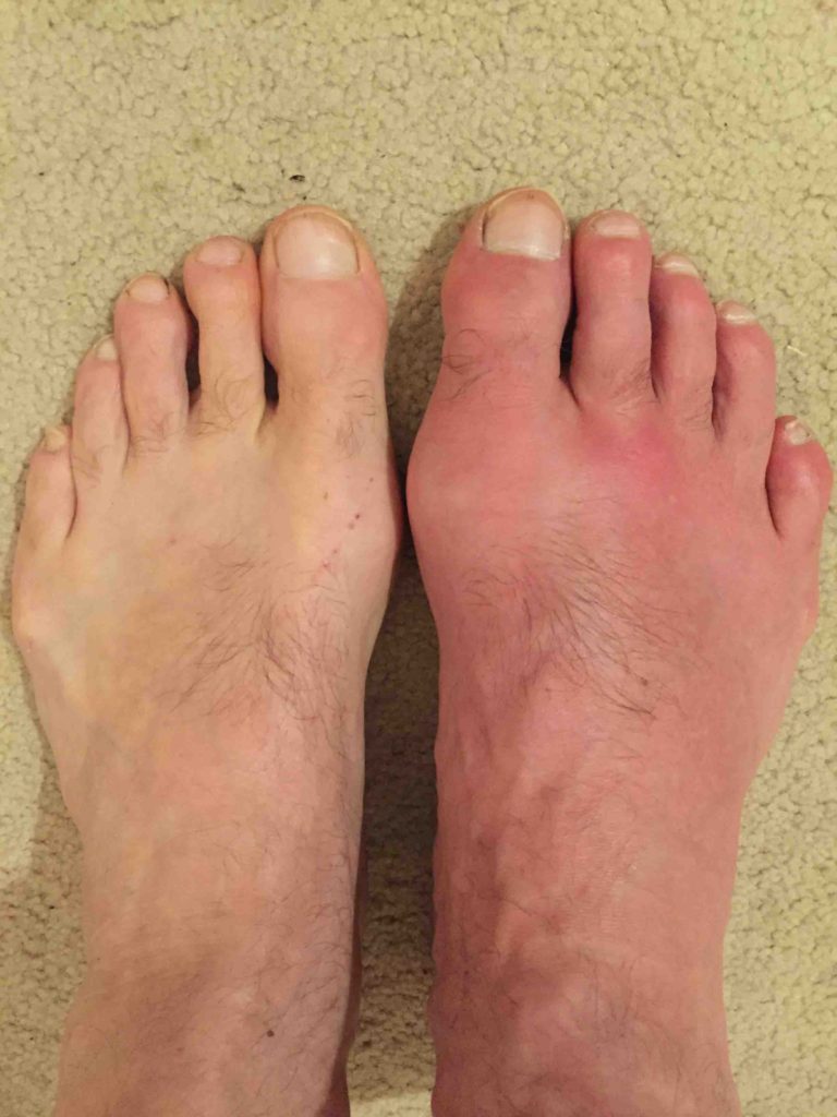 Gout : causes , symptoms , diagnosis &  physiotherapy treatment