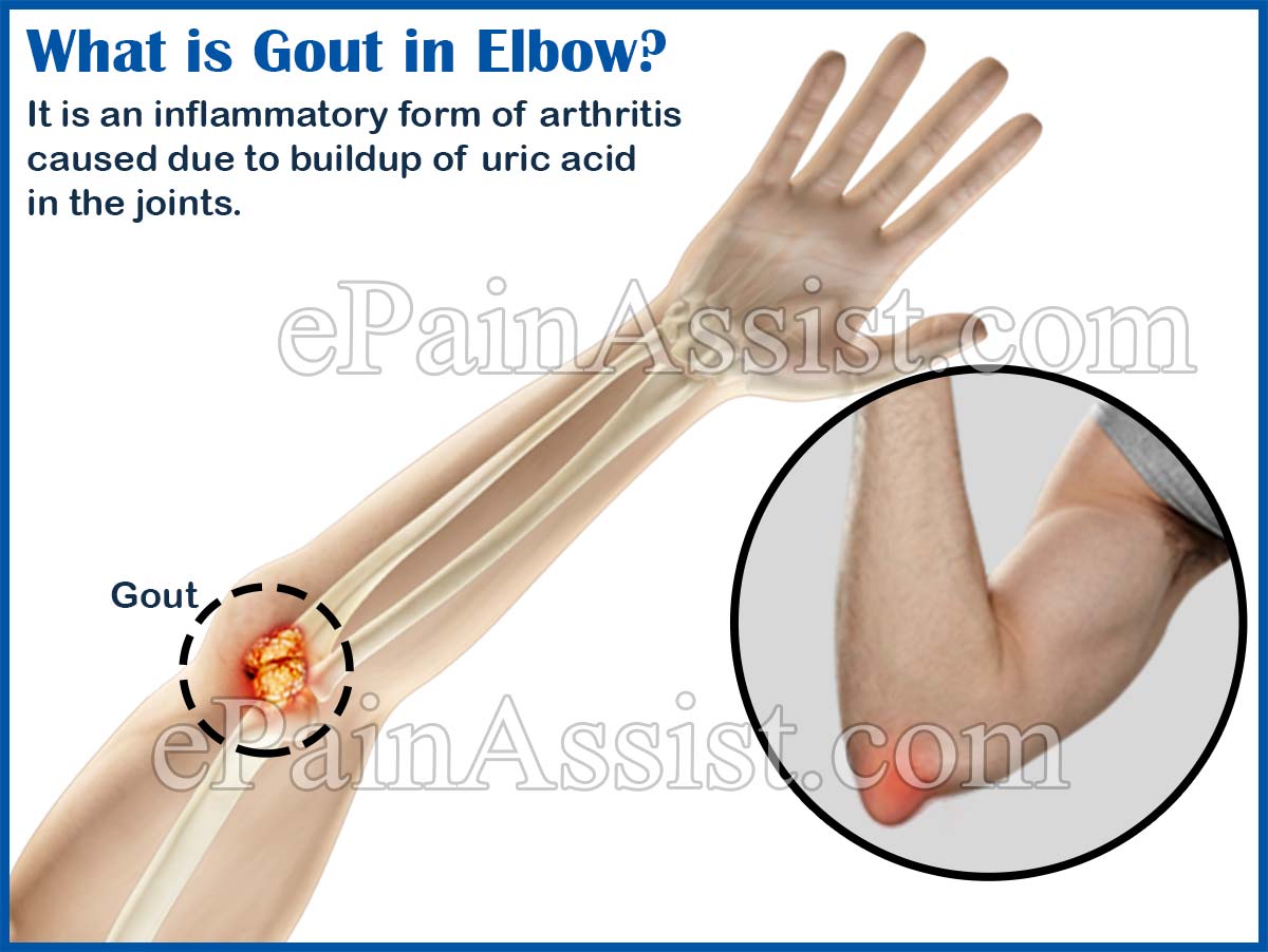 Gout in Elbow