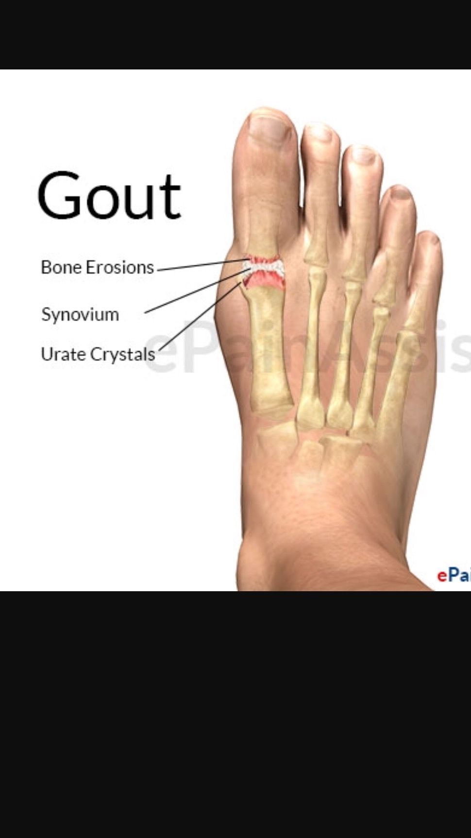 Gout is no laughing matter. Gout of here. Ok, Gout really is no ...