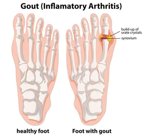 Gout Puts Men at Higher Risk of ED