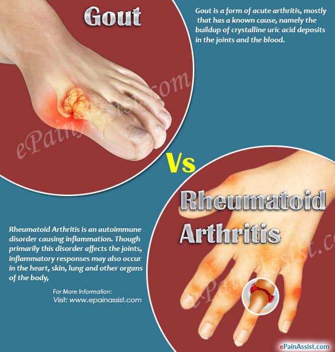 Gout Vs Rheumatoid Arthritis: Differences Worth Knowing