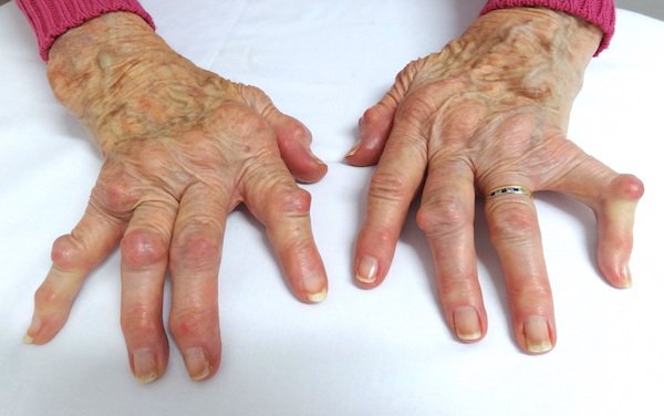 Hand osteoarthritis