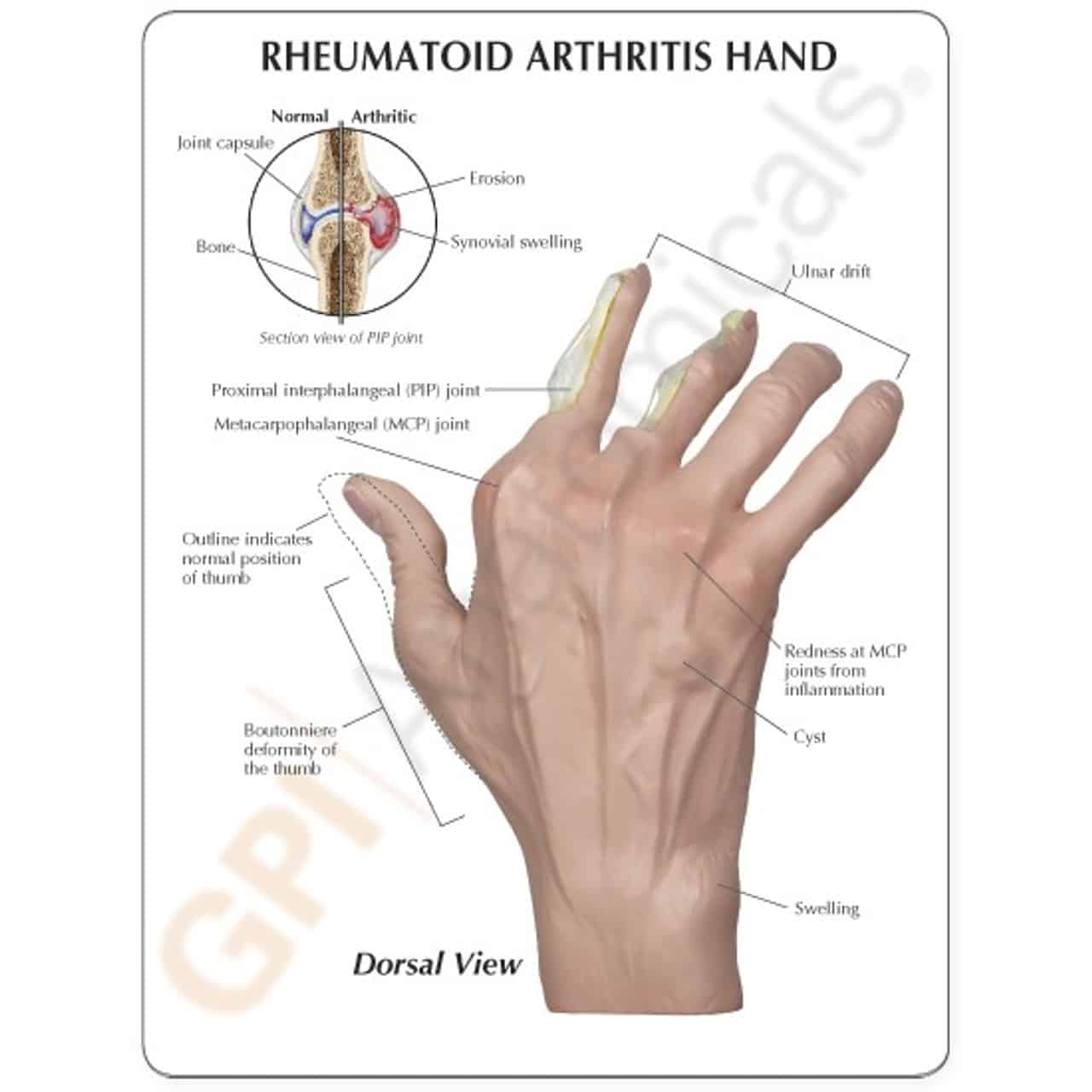 Hand Rheumatoid Arthritis Model
