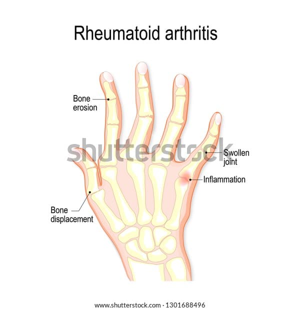 Hand Rheumatoid Arthritis Typical Joint Swelling Stock Vector (Royalty ...
