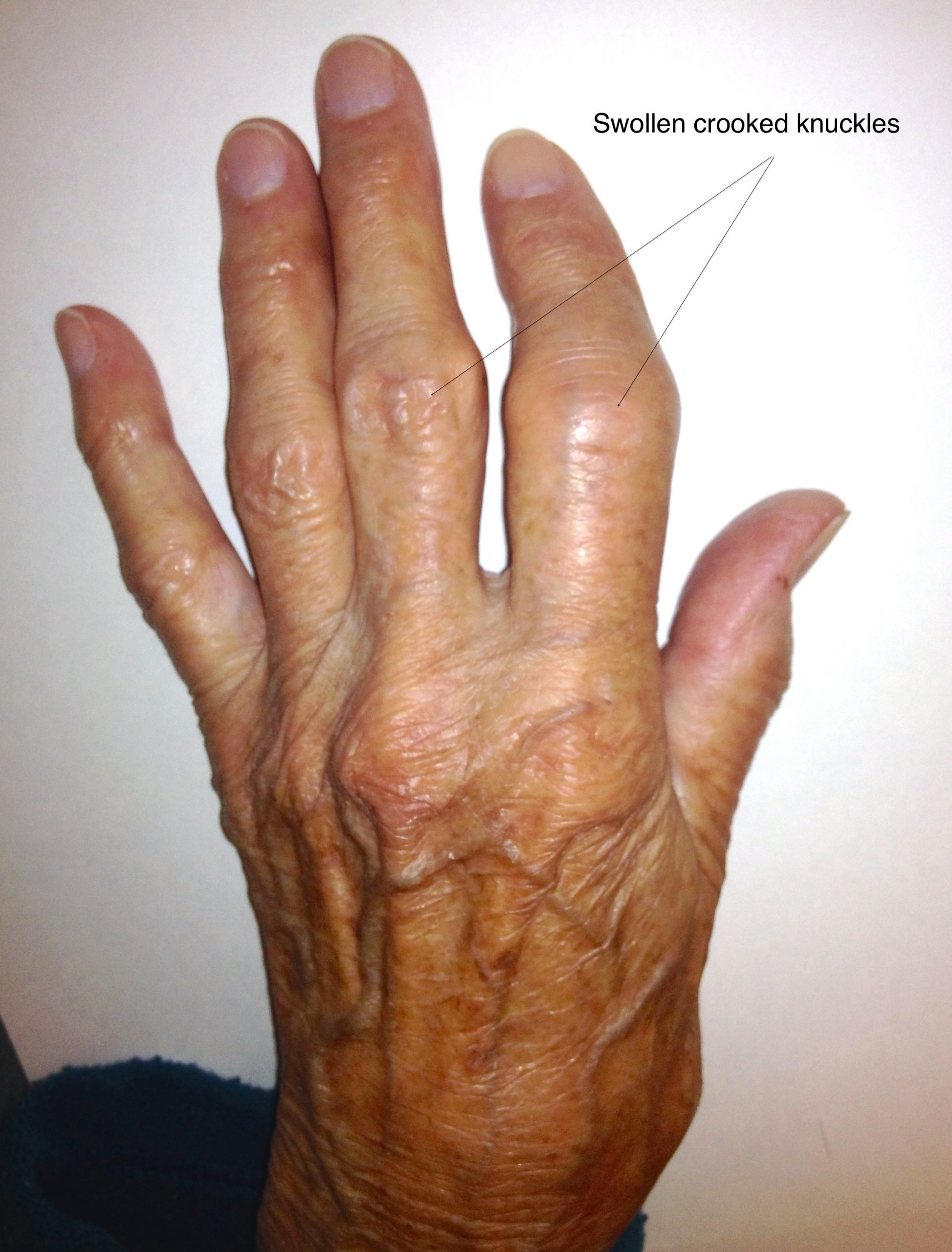 Hands  Arthritis