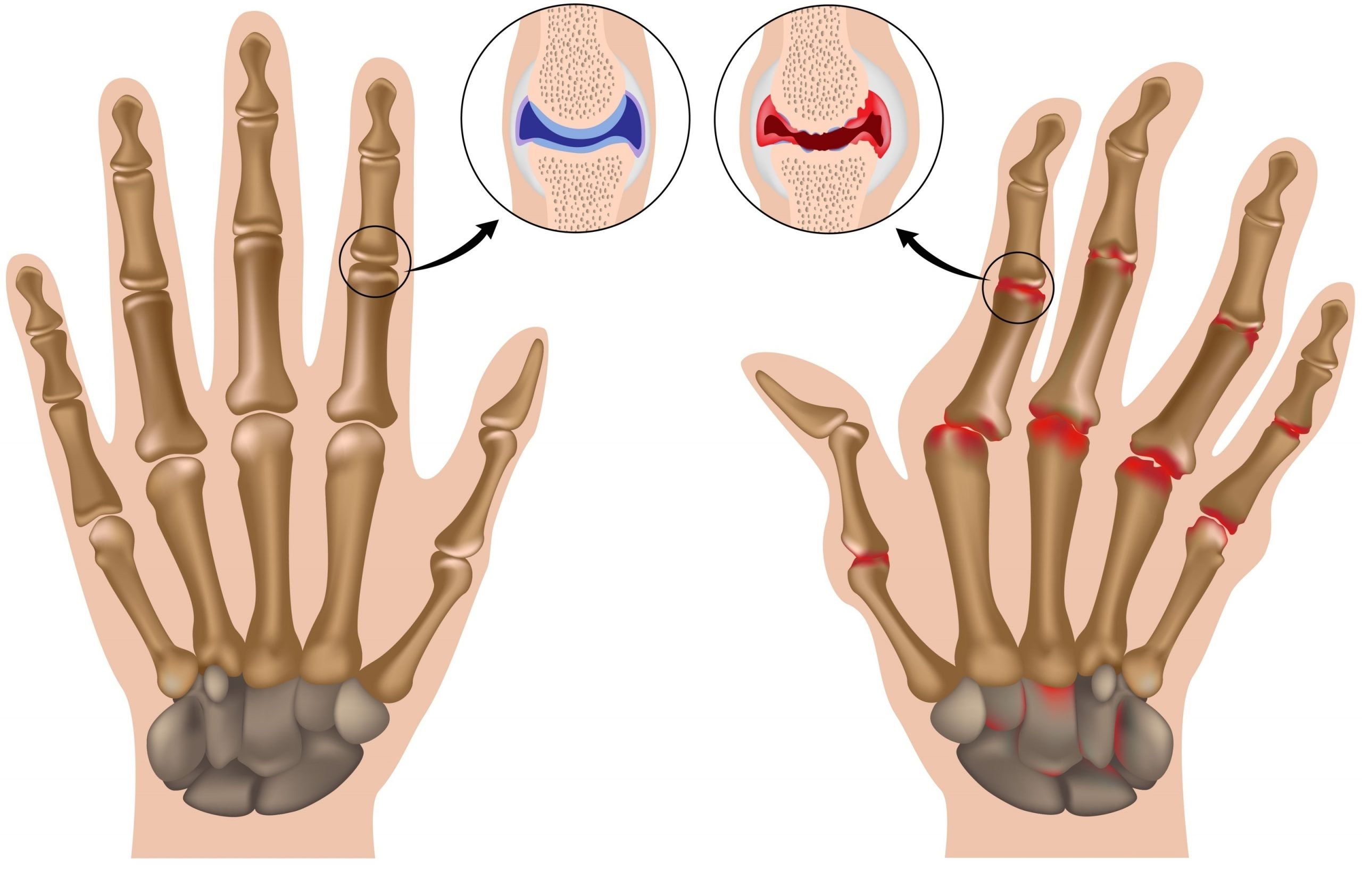 Hands  Arthritis « Oxford Orthopaedics