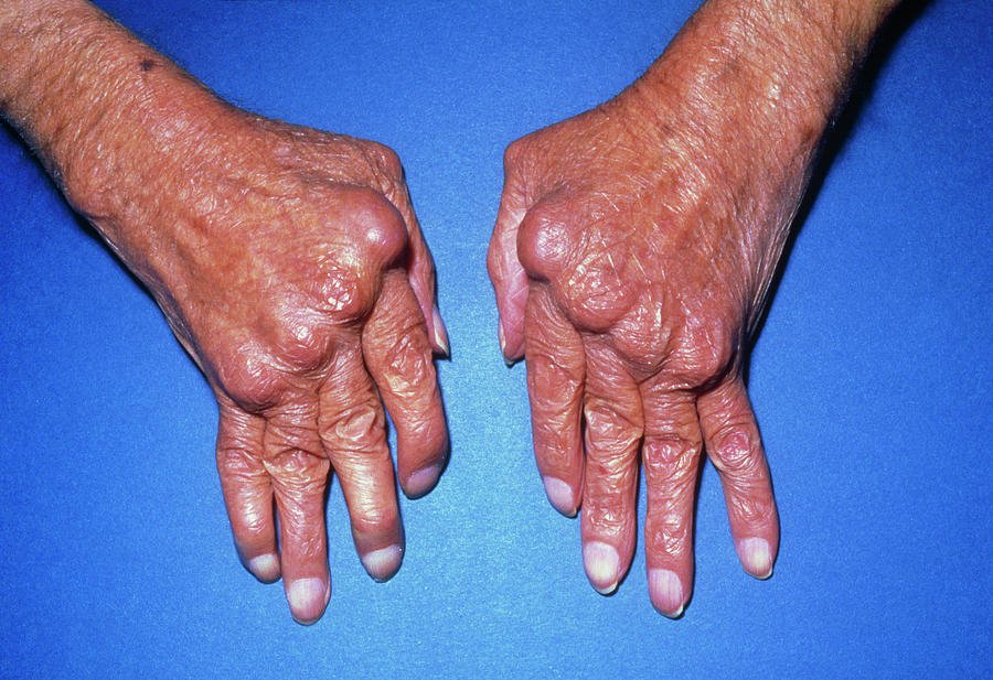 Hands With Rheumatoid Arthritis Photograph by James Stevenson/science ...