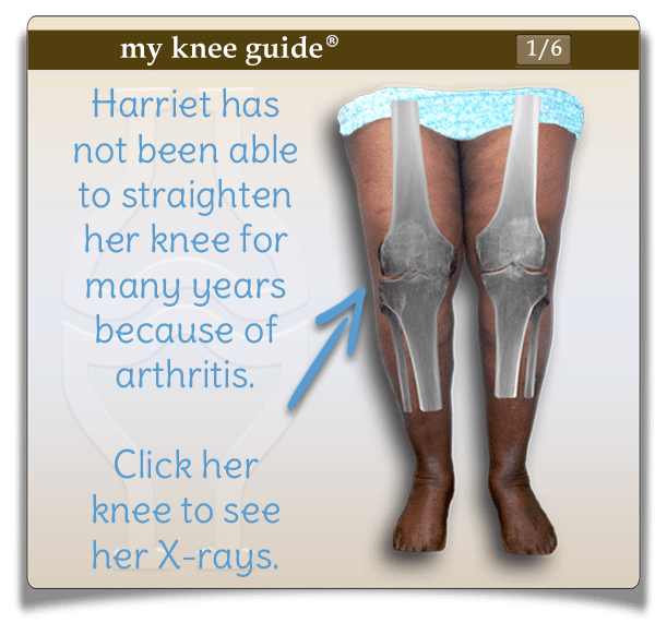 Harriet: Large bone spurs were removed from the back of Harriets