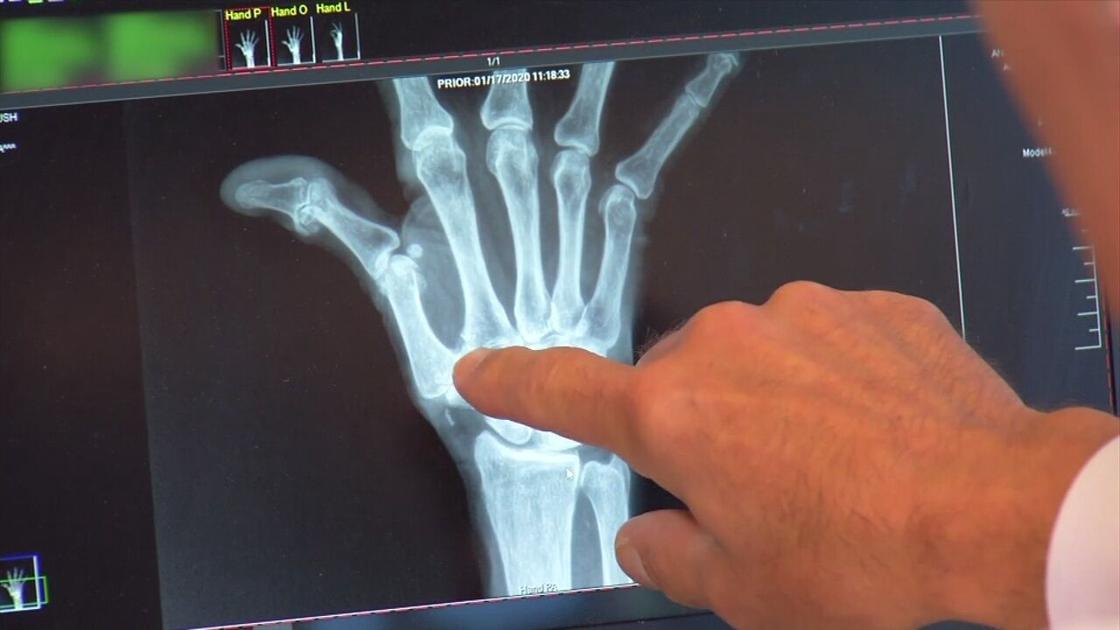 Health Beat: CMC surgery for thumb arthritis
