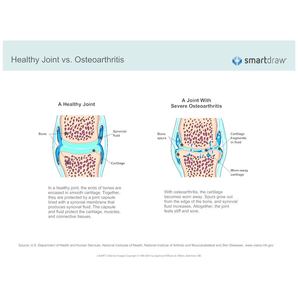 Healthy Joint vs Osteoarthritis