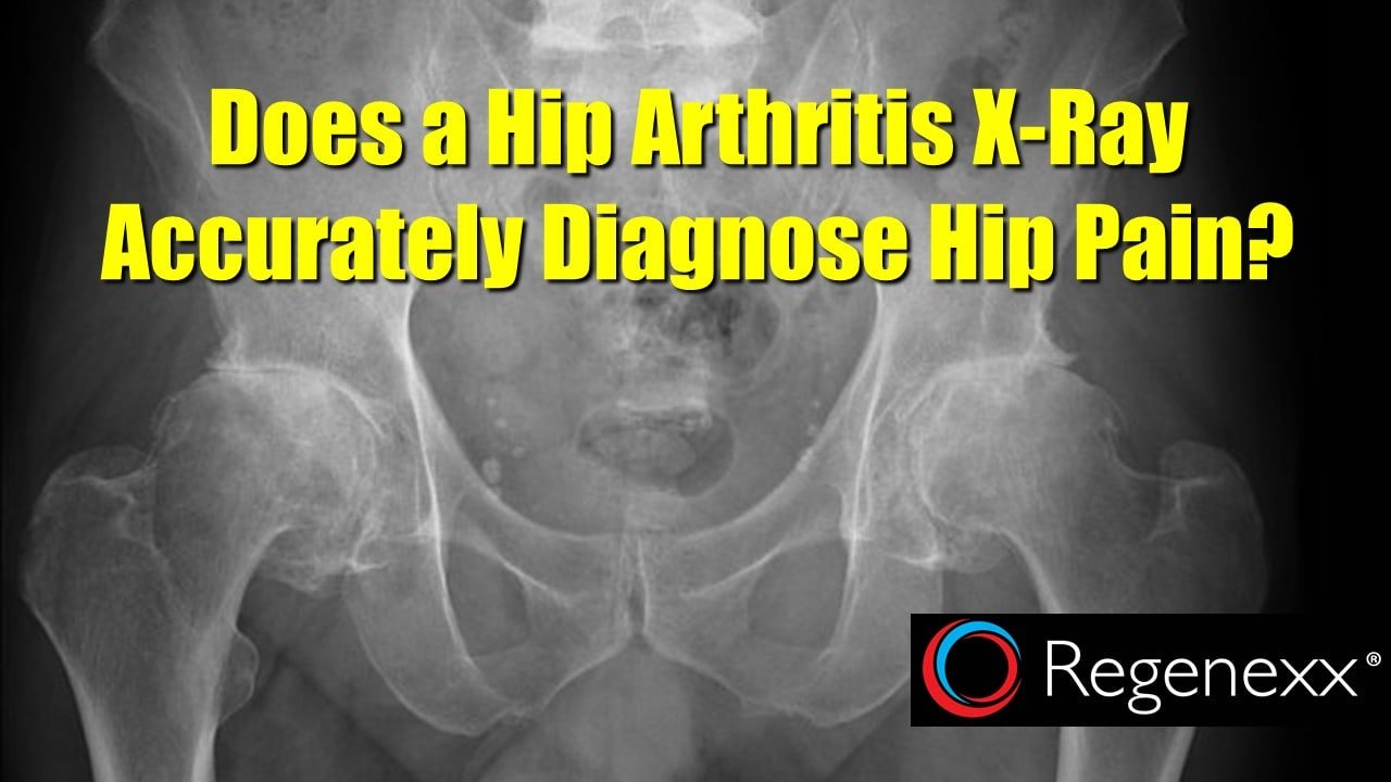 hip arthritis x