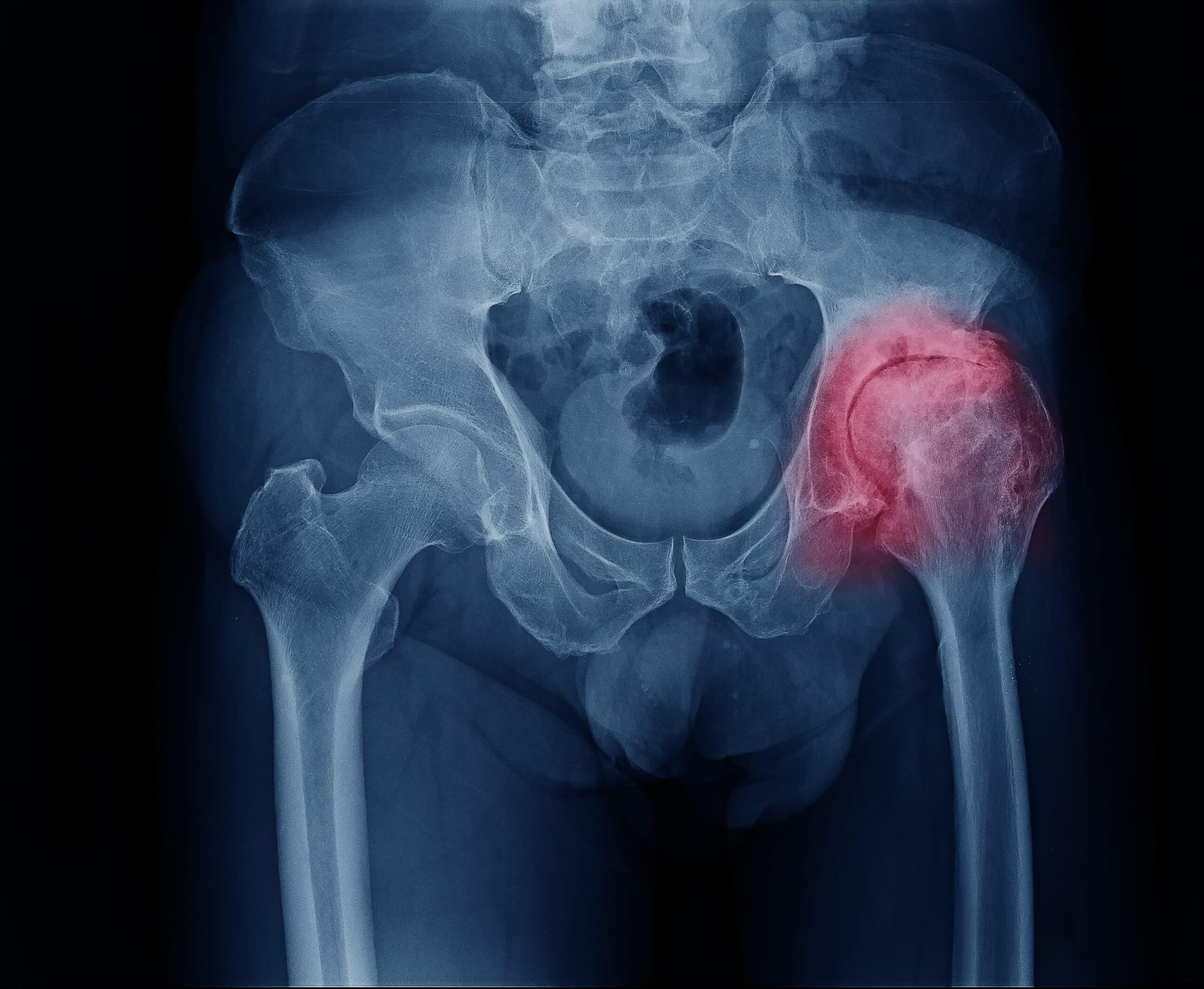 Hip Impingement: A Cause of Early Onset Hip Arthritis in Young Adults