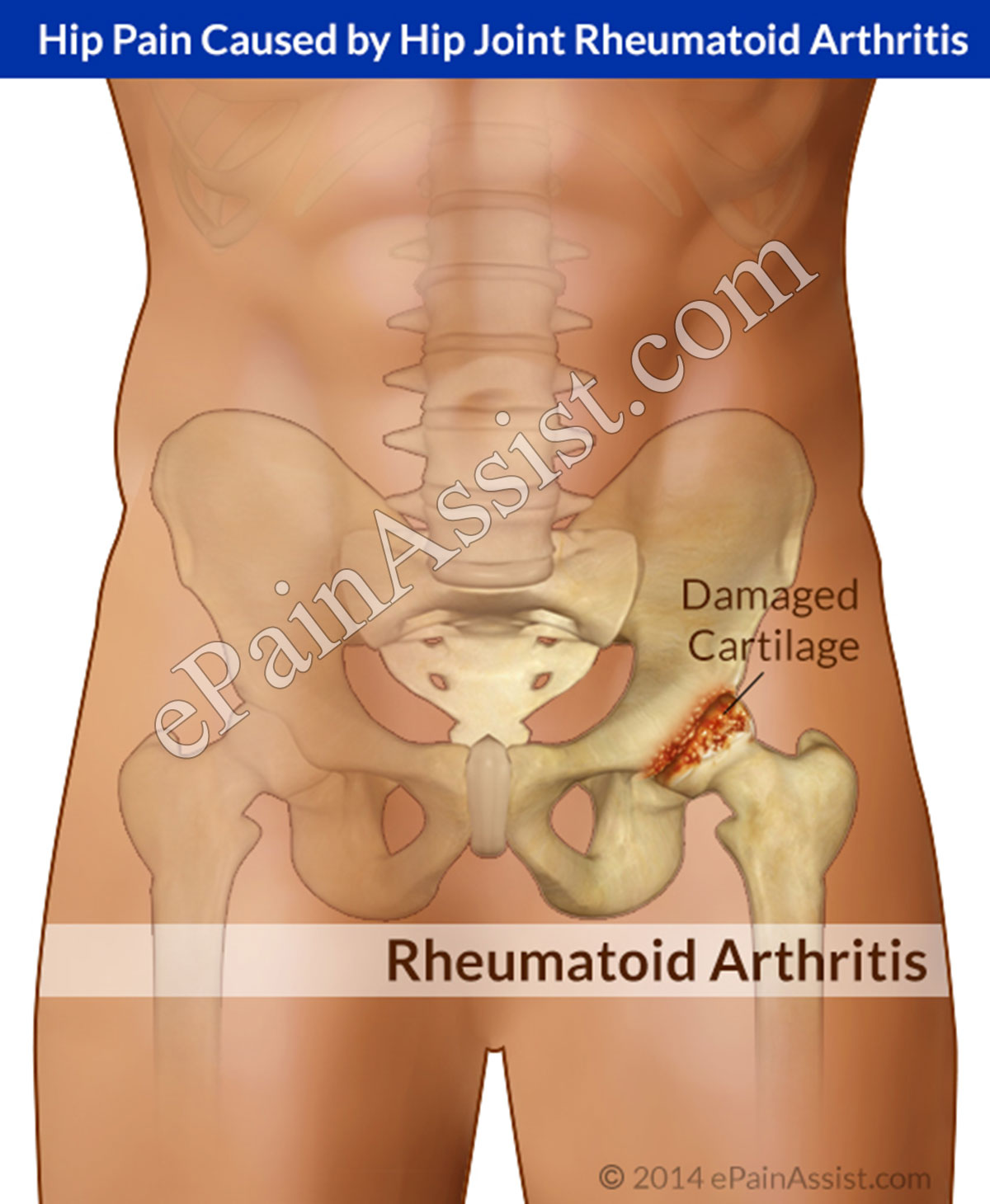 Hip Joint Rheumatoid Arthritis: Causes