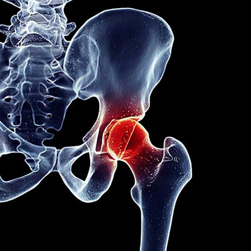 Hip Osteoarthritis Causes, Symptoms, Diagnosis &  Treatment