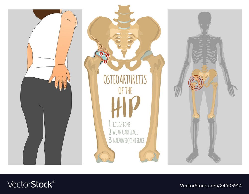Hip osteoarthritis infographic Royalty Free Vector Image