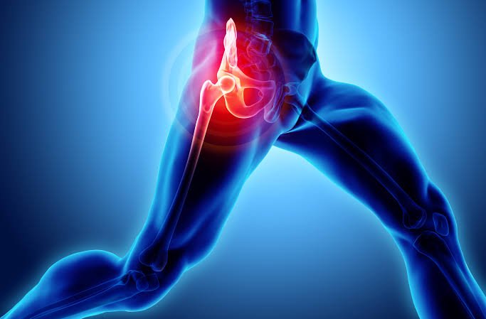 HIP PAIN: is it arthritis or something else?