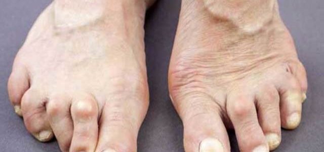 Home Remedies For Rheumatoid Arthritis In Feet