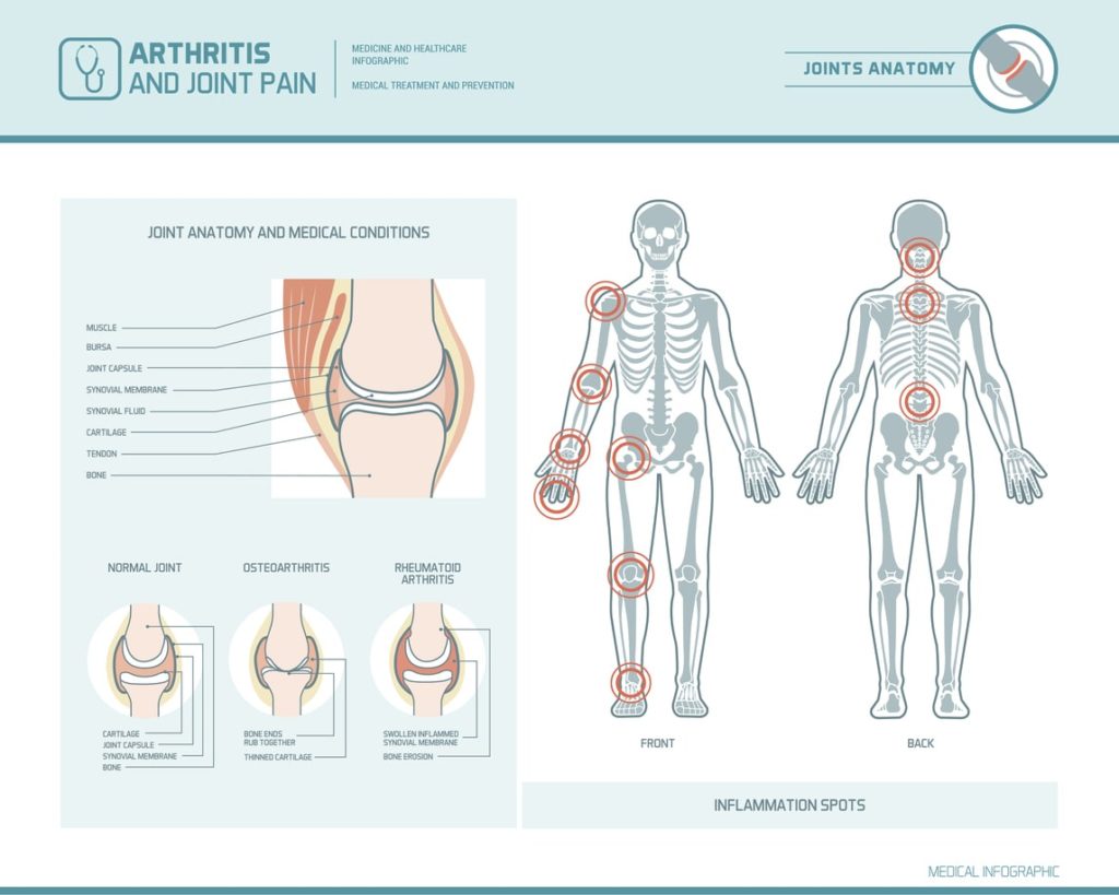 How an Arthritis Treatment Center Can Help With Your Pain ...