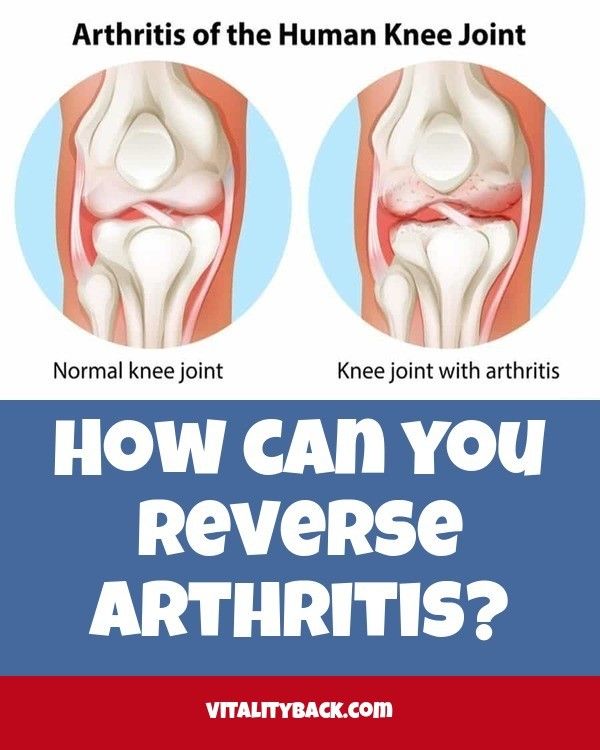 How can you reverse arthritis? Check the webpage to learn more https ...