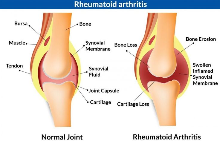 How Can You Tell If You Have Arthritis