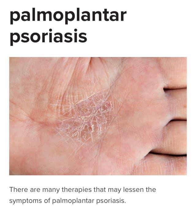 How Can You Tell If You Have Psoriatic Arthritis