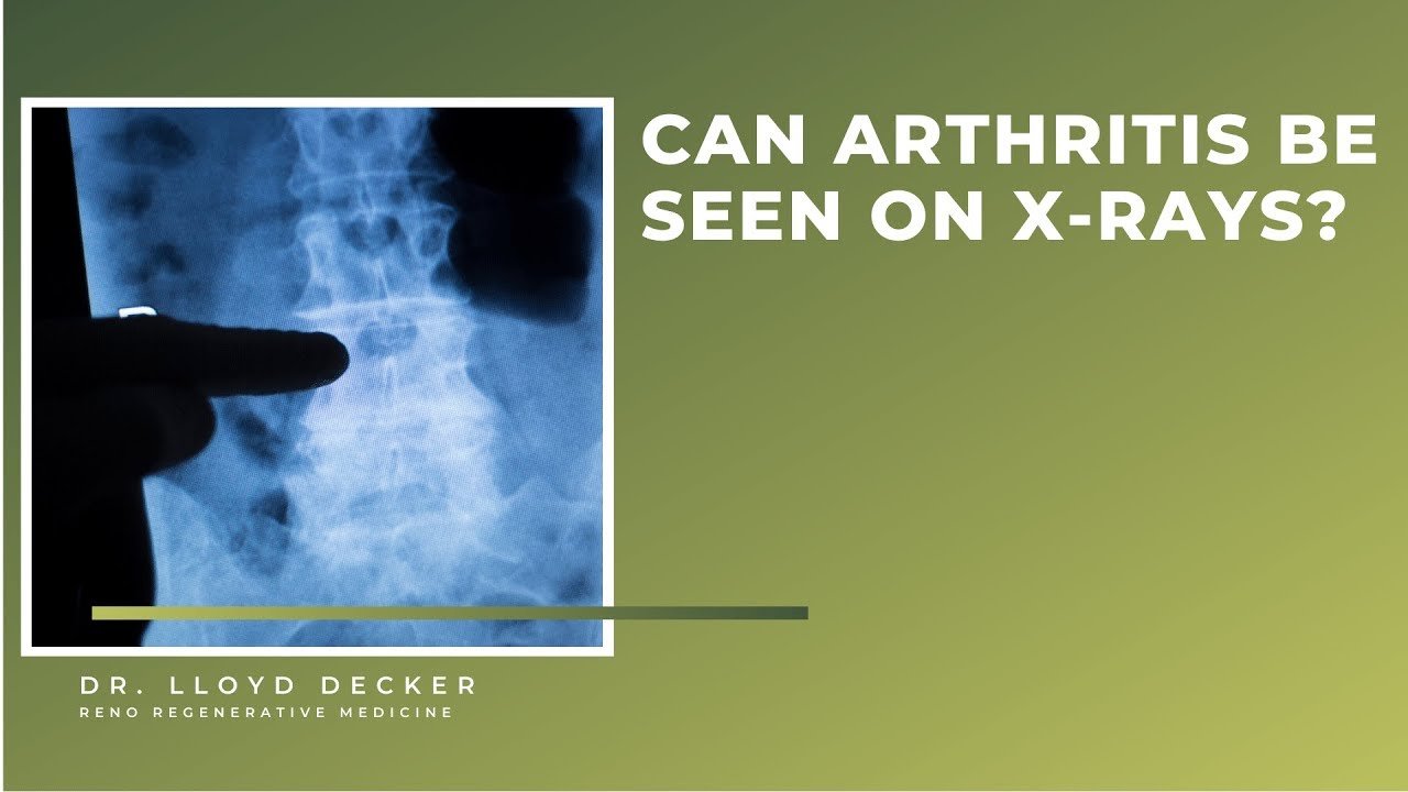 HOW DO YOU DIAGNOSE ARTHRITIS? CAN YOU SEE IT ON AN X RAY ...