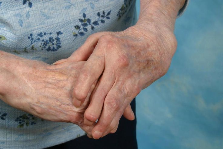 How do you manage arthritis in hands?