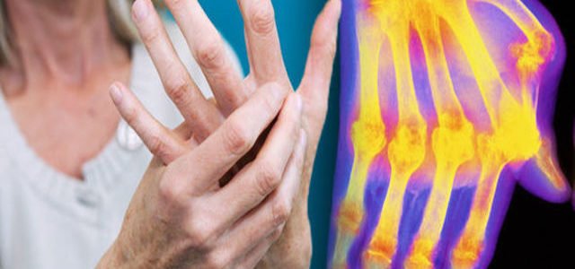 How Do You Say Rheumatoid Arthritis In Portuguese
