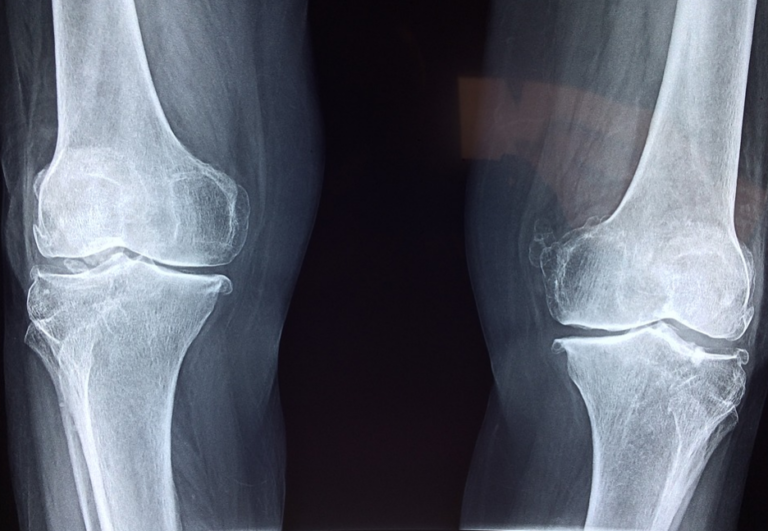 How does psoriatic arthritis affect the knee?