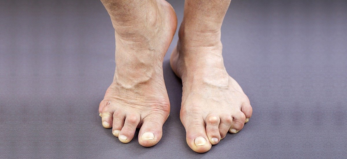 How does Rheumatoid Arthritis affect my feet?