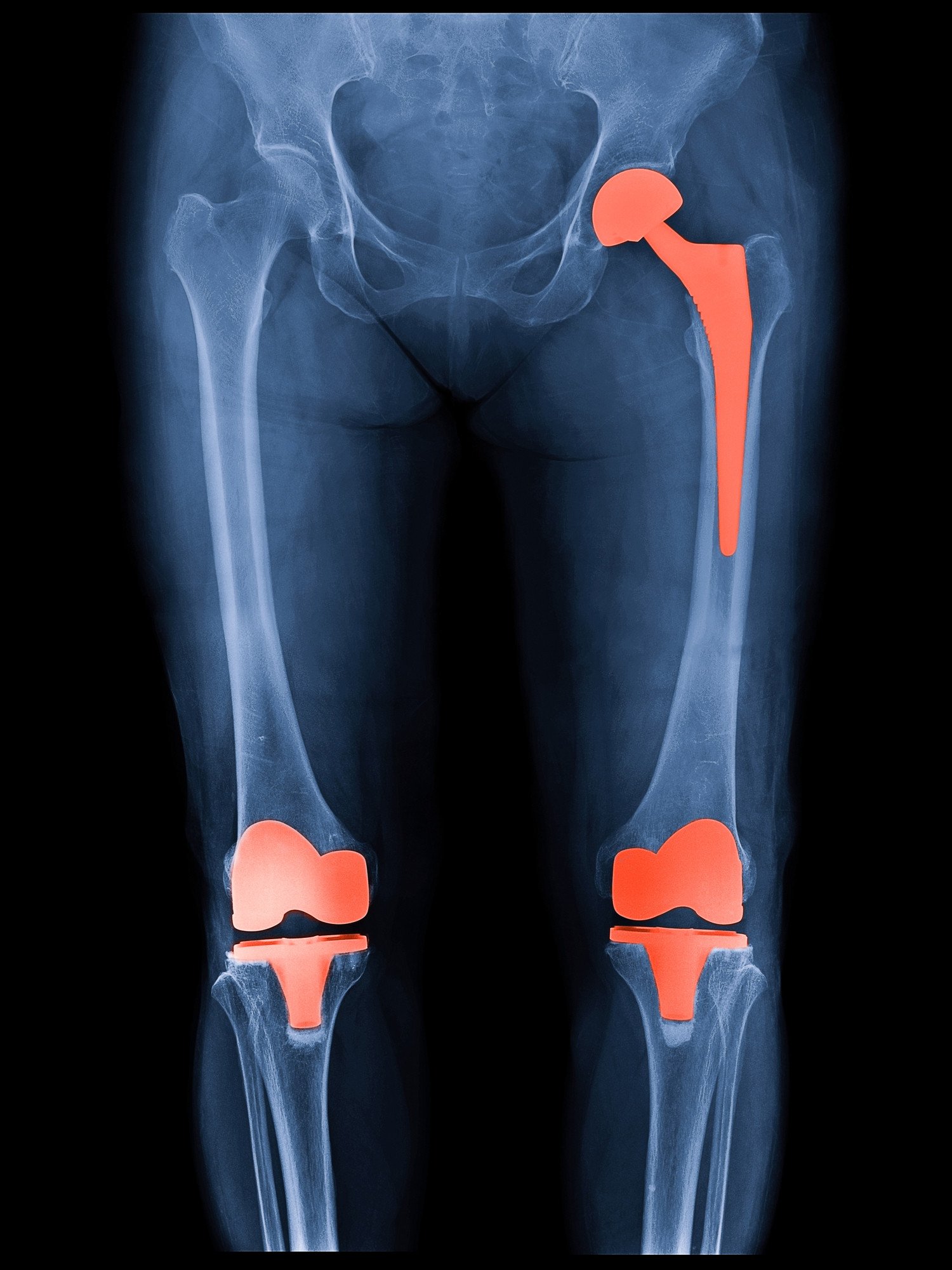 How long will my hip or knee replacement last?