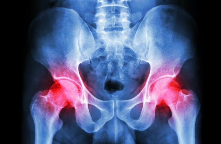 How Rheumatoid Arthritis Affects the Hips