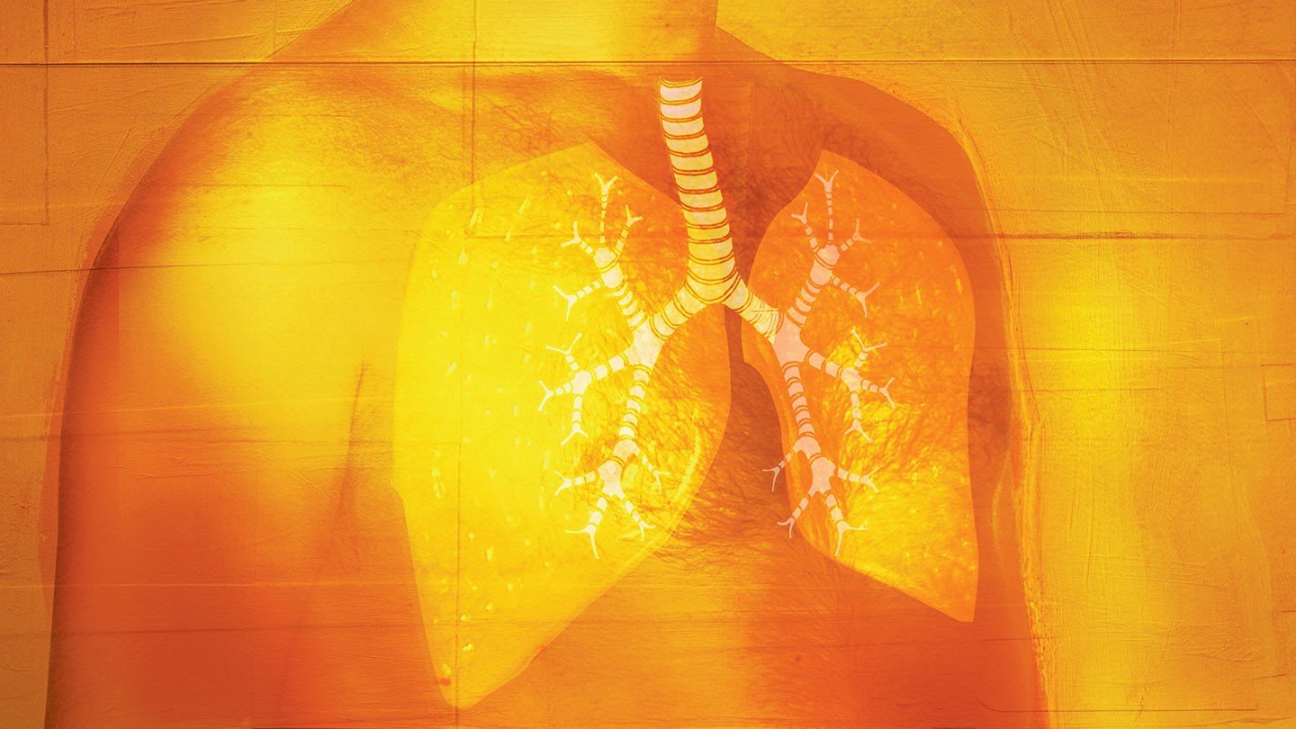 How Rheumatoid Arthritis Affects the Lungs